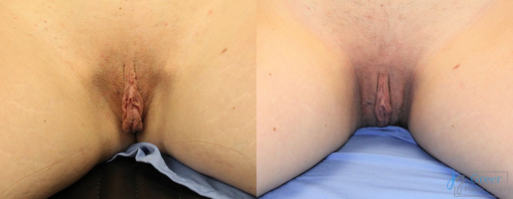 Before and after Labiaplasty case 19895