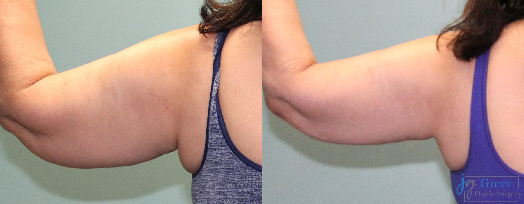 Liposuction - Thumbnail 4