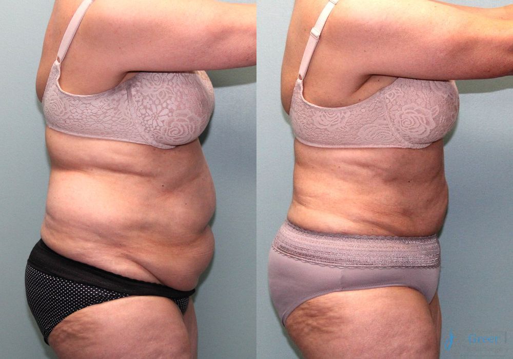 Liposuction - Thumbnail 2