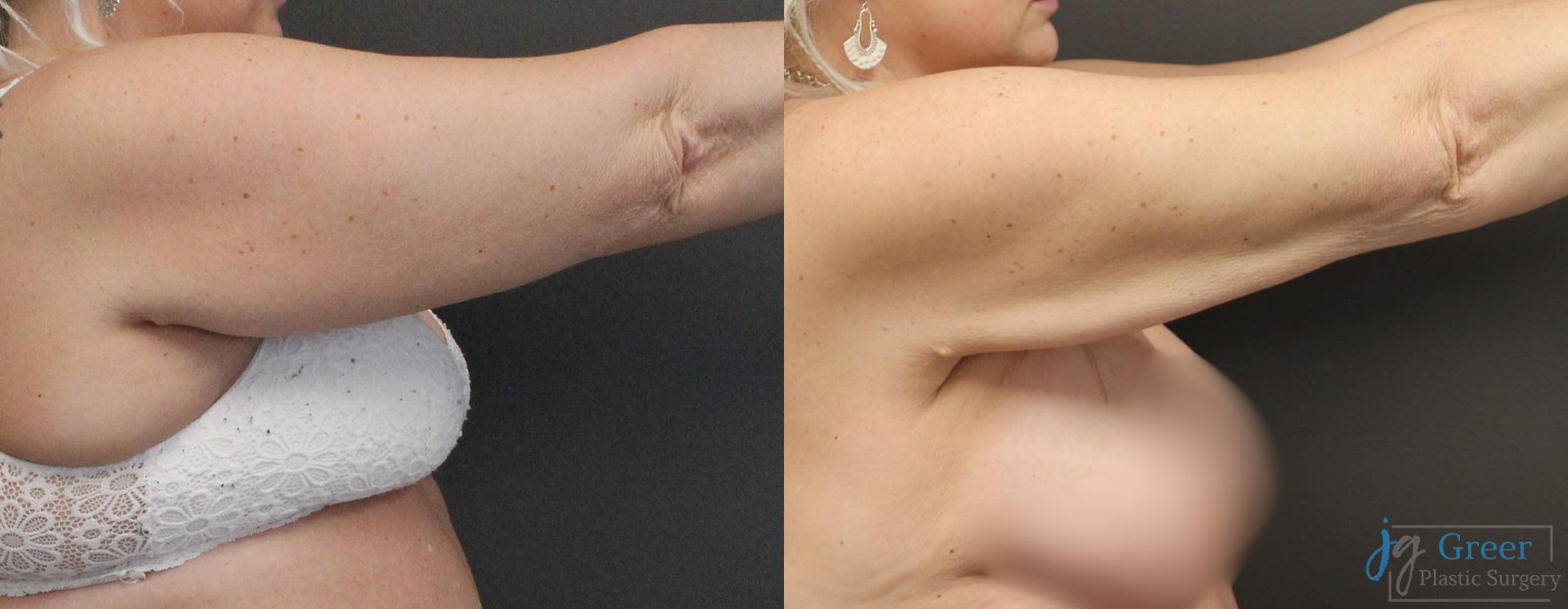 Liposuction - Thumbnail 3