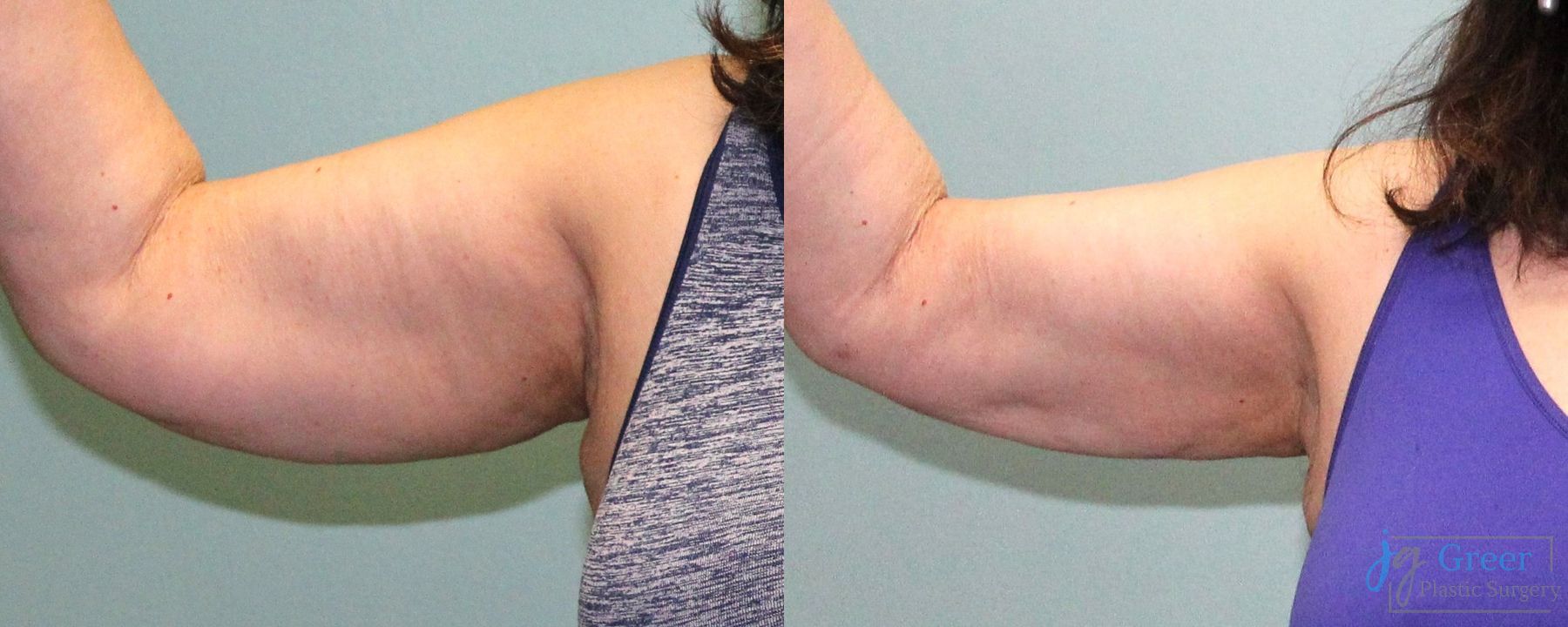 Before and after Liposuction case 19868