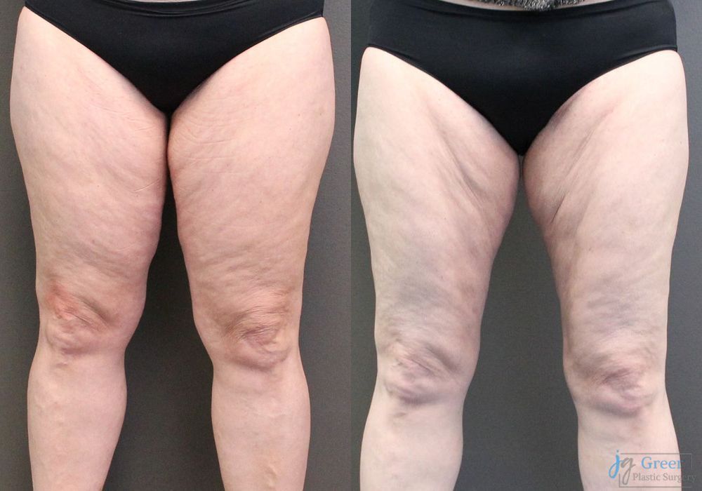 Liposuction - Case 2327