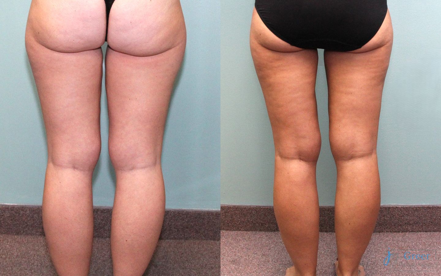 Before and after Liposuction case 19870 - Angle 2