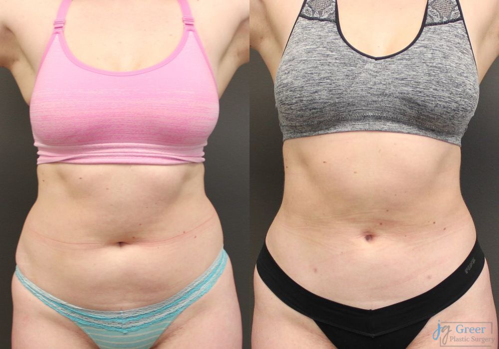 Liposuction - Case 2331