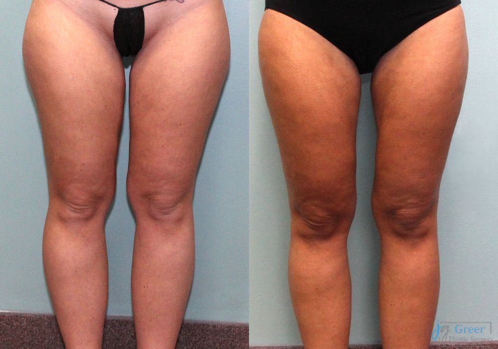 Liposuction - Case 2669