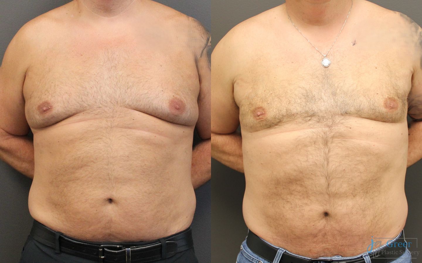 Before and after Liposuction case 19874