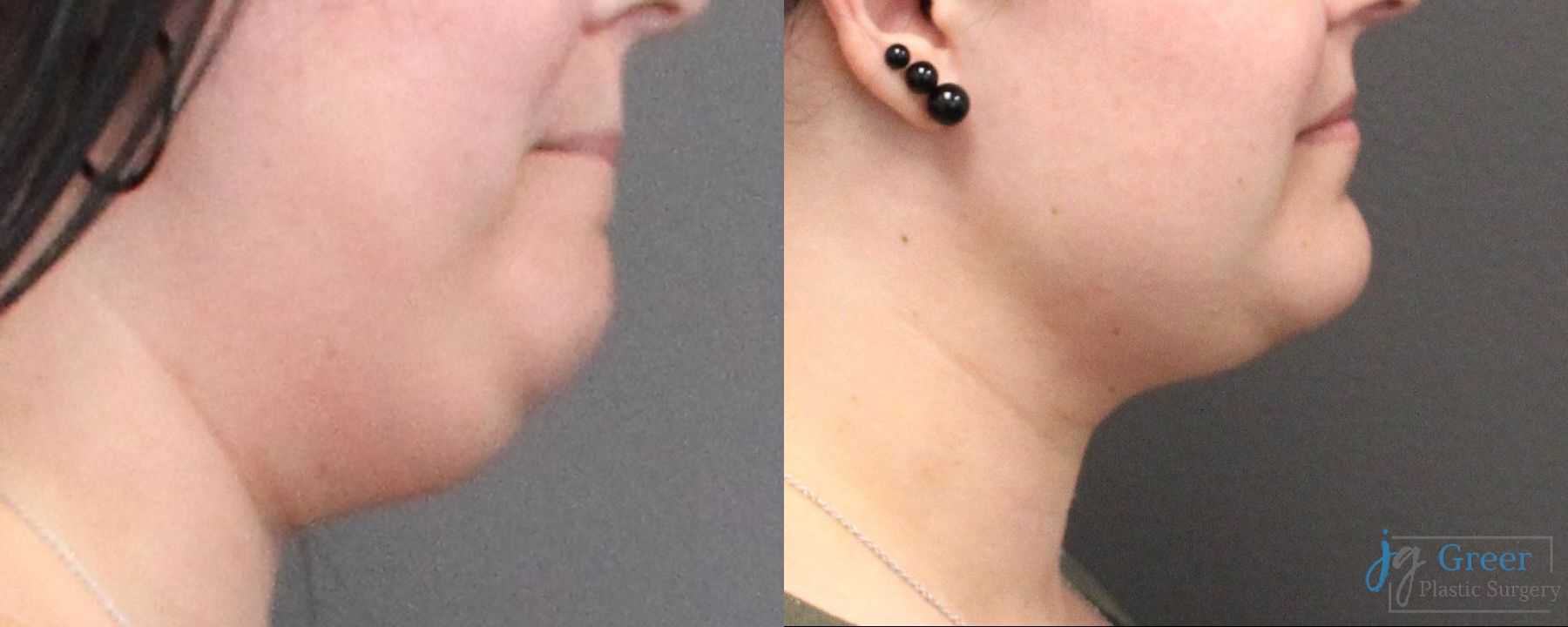 Before and after Liposuction case 19880 - Angle 2