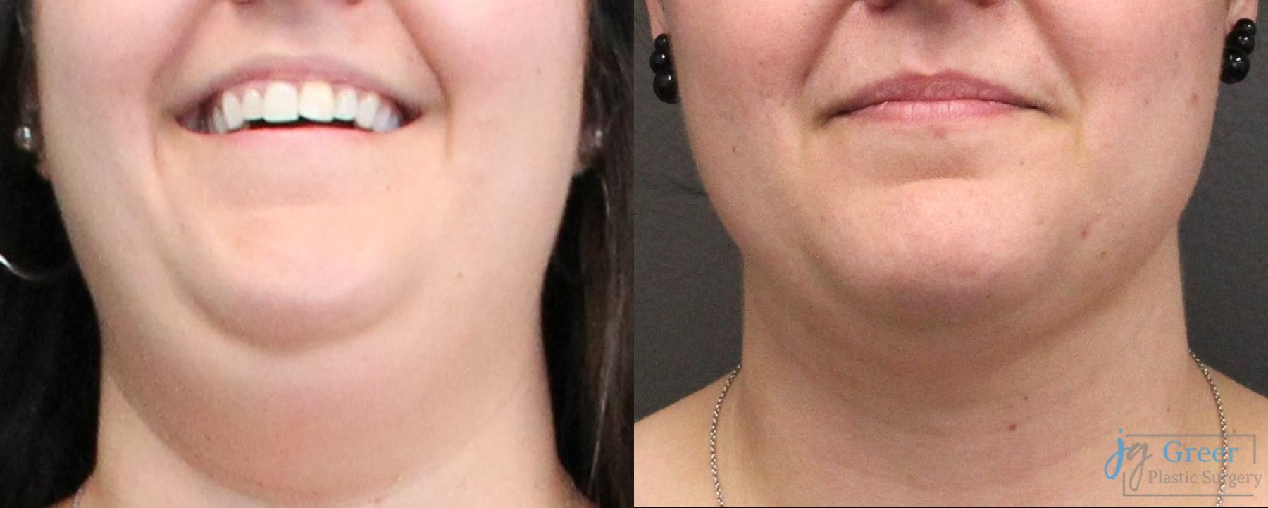 Before and after Liposuction case 19880