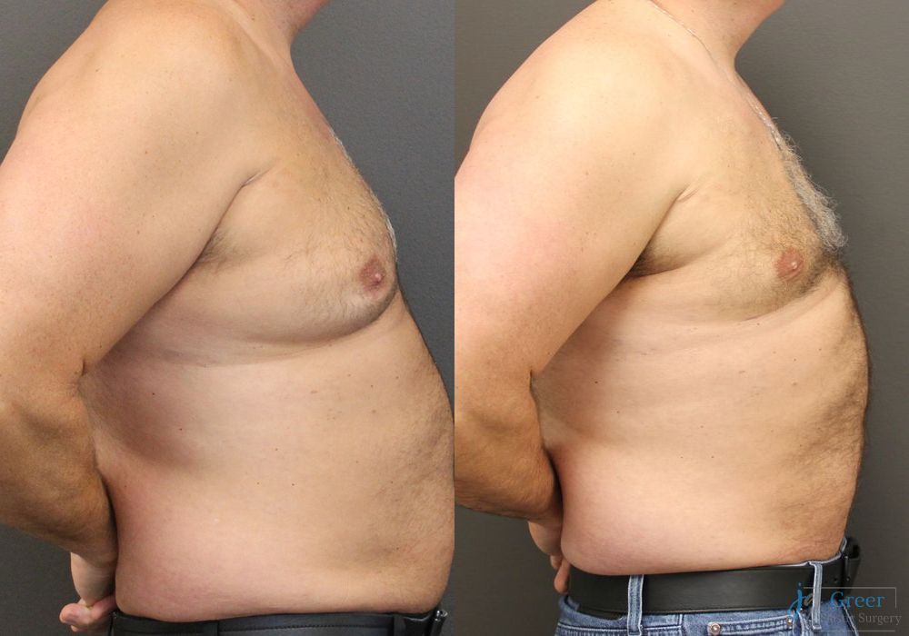 Gynecomastia - Thumbnail 3