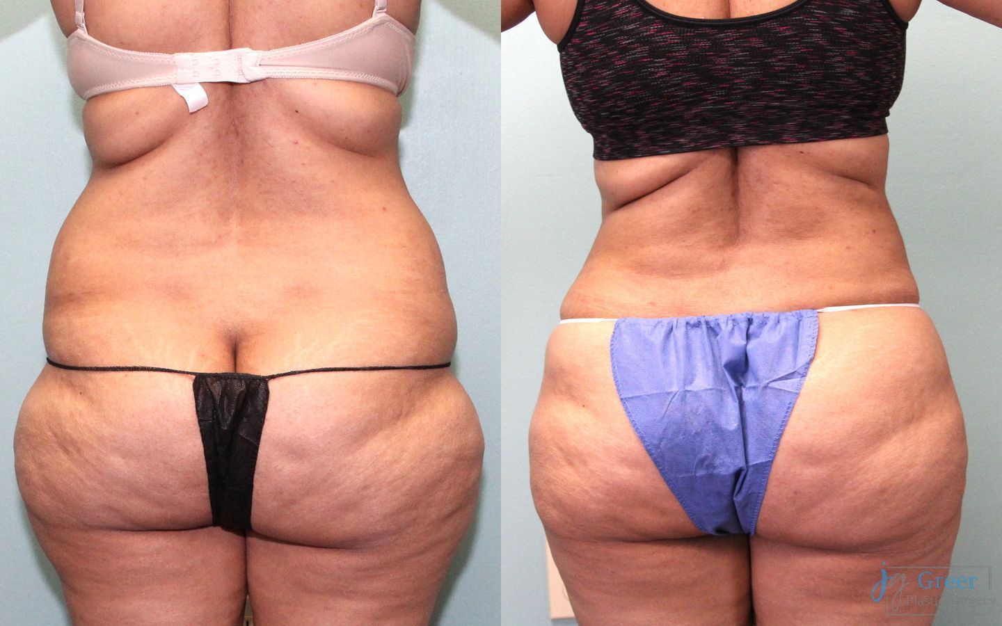 Before and after Liposuction case 19865 - Angle 2