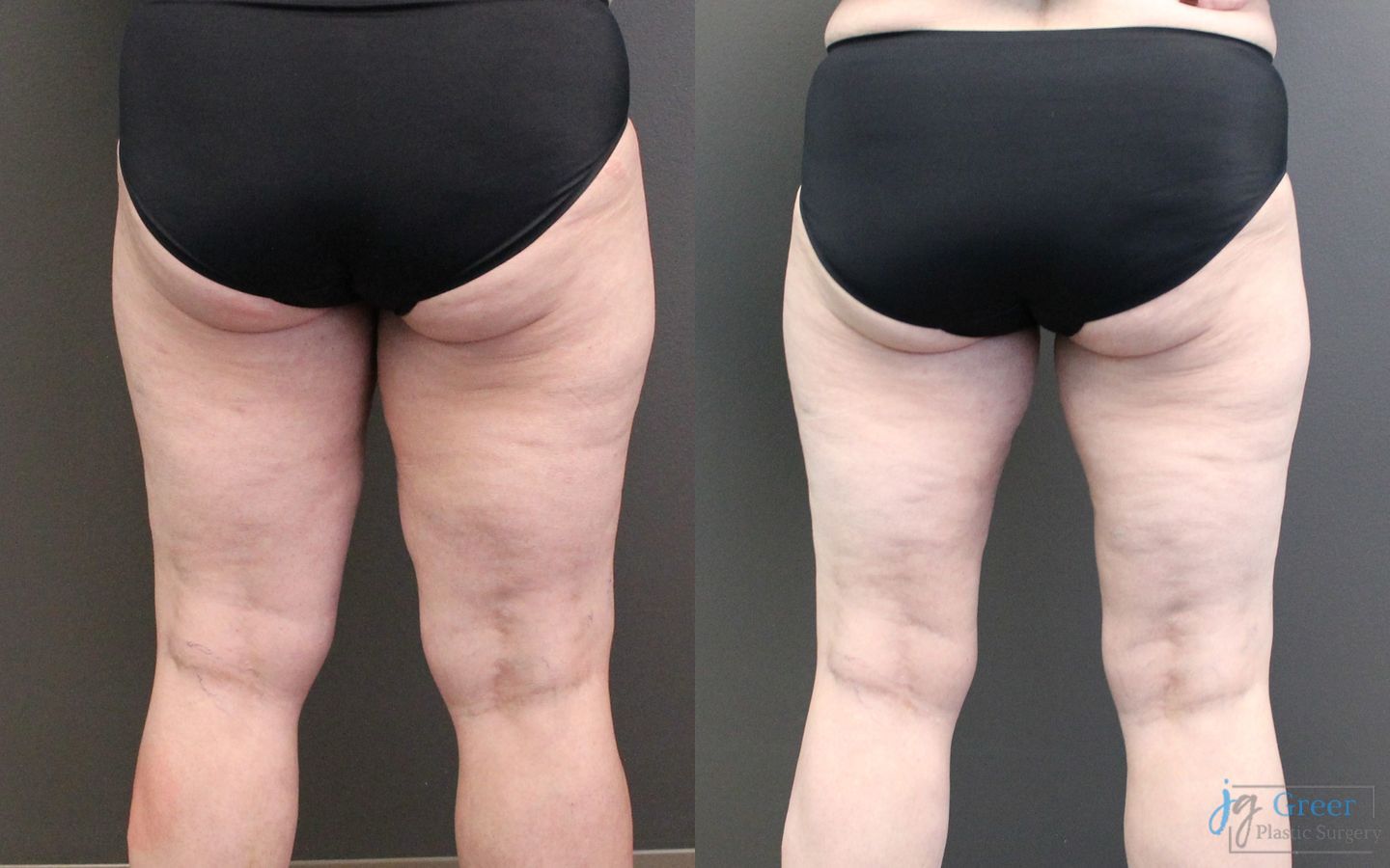 Before and after Liposuction case 19871 - Angle 2