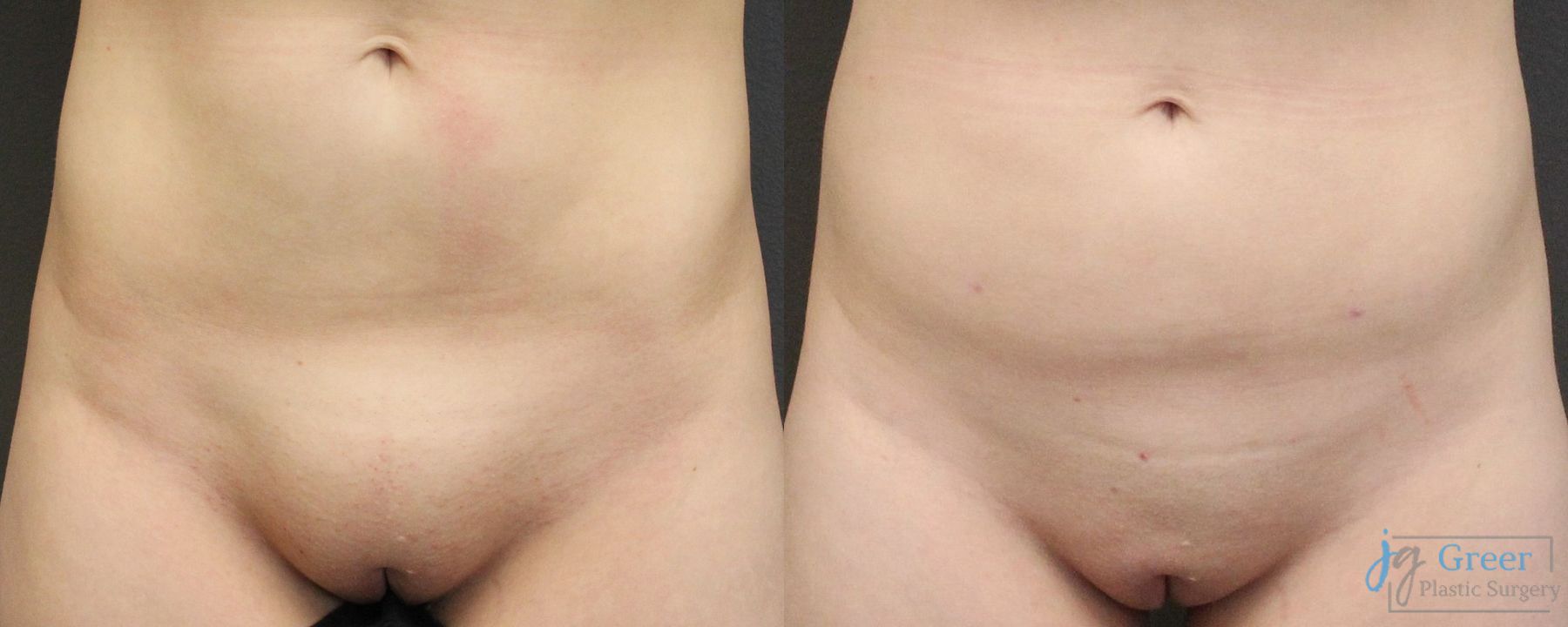 Before and after Monsplasty case 19872