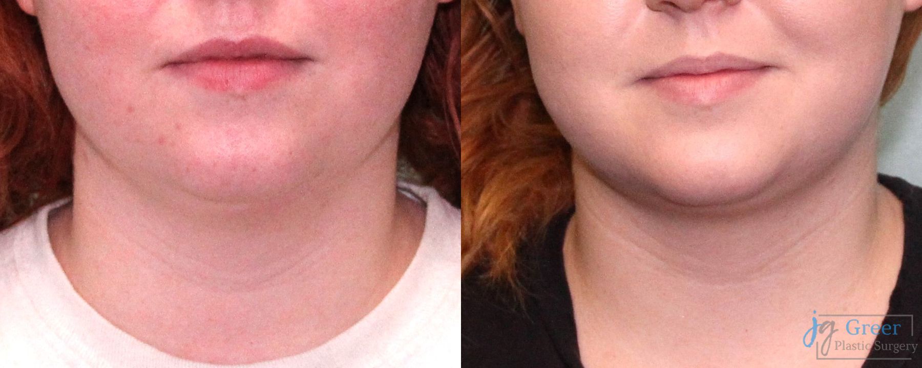Before and after Liposuction case 19879