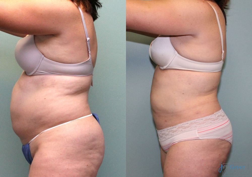 Liposuction - Thumbnail 3