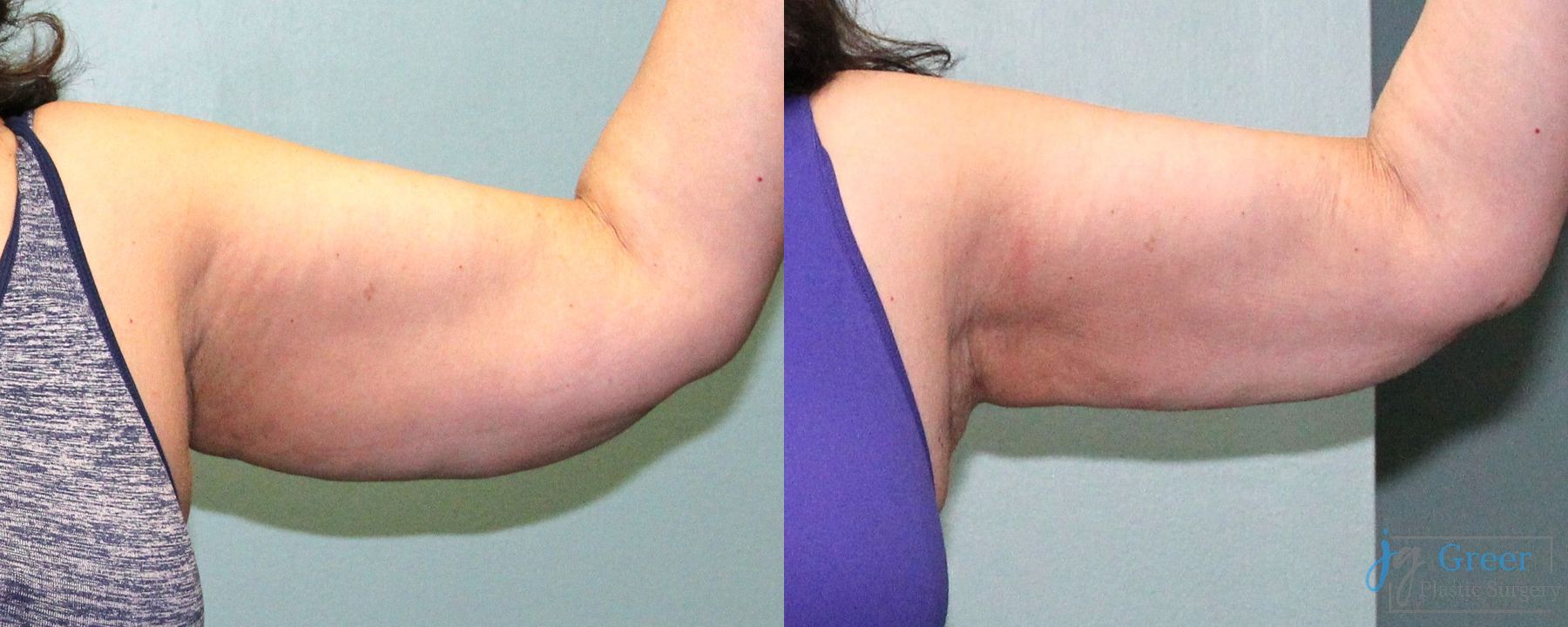 Before and after Liposuction case 19868 - Angle 3