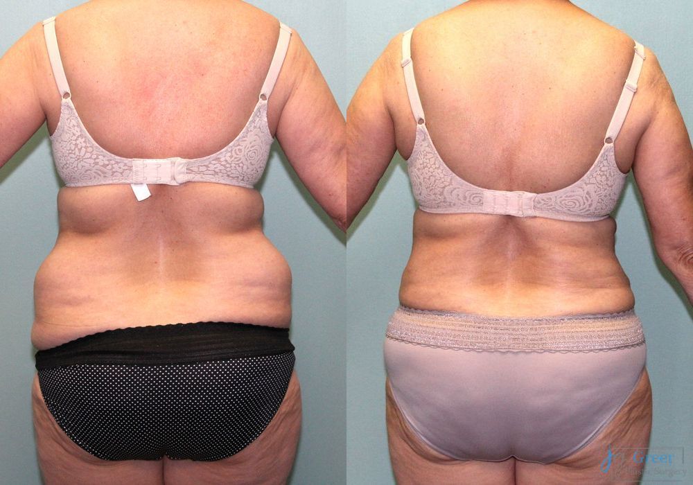 Liposuction - Thumbnail 3