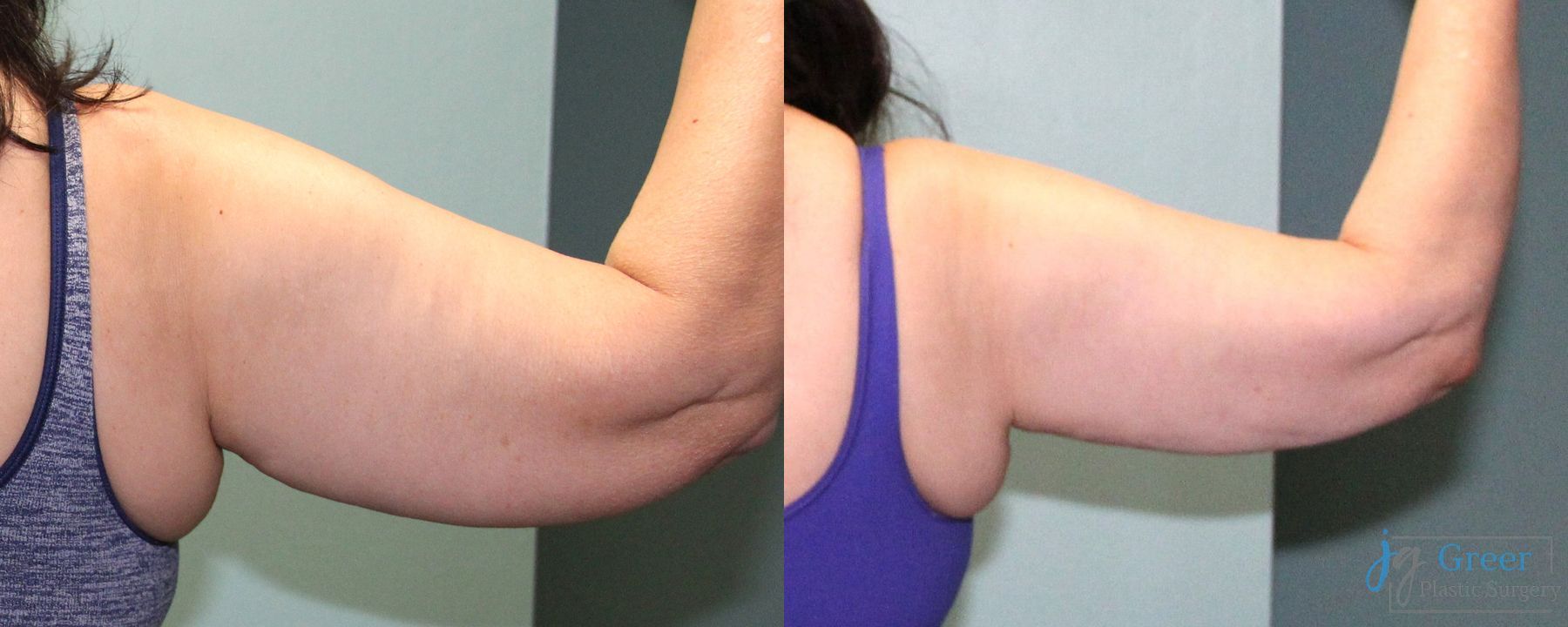 Before and after Liposuction case 19868 - Angle 2