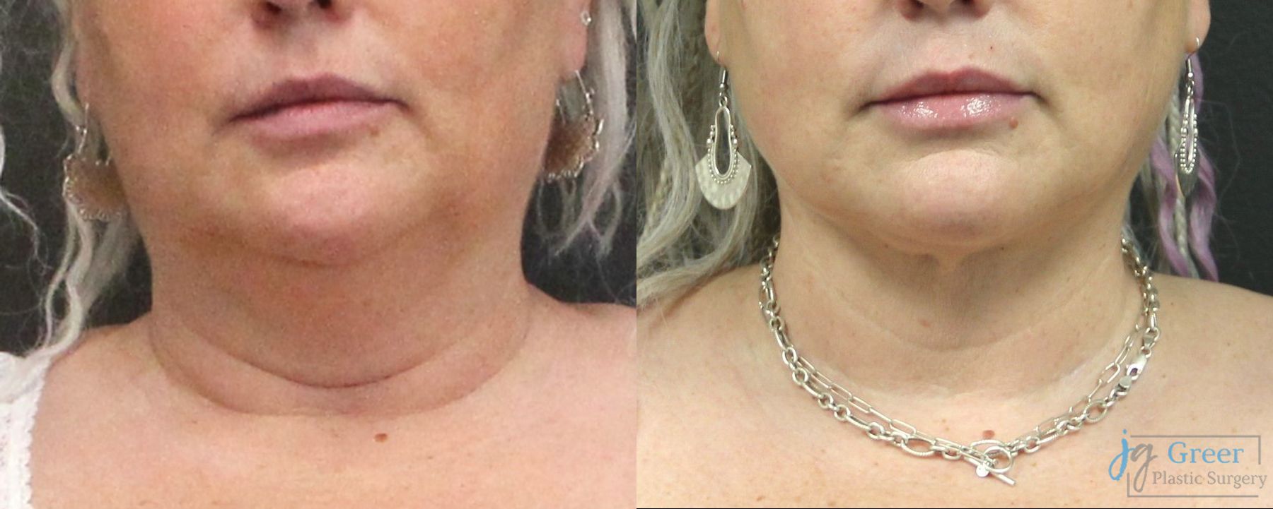 Before and after Liposuction case 19881