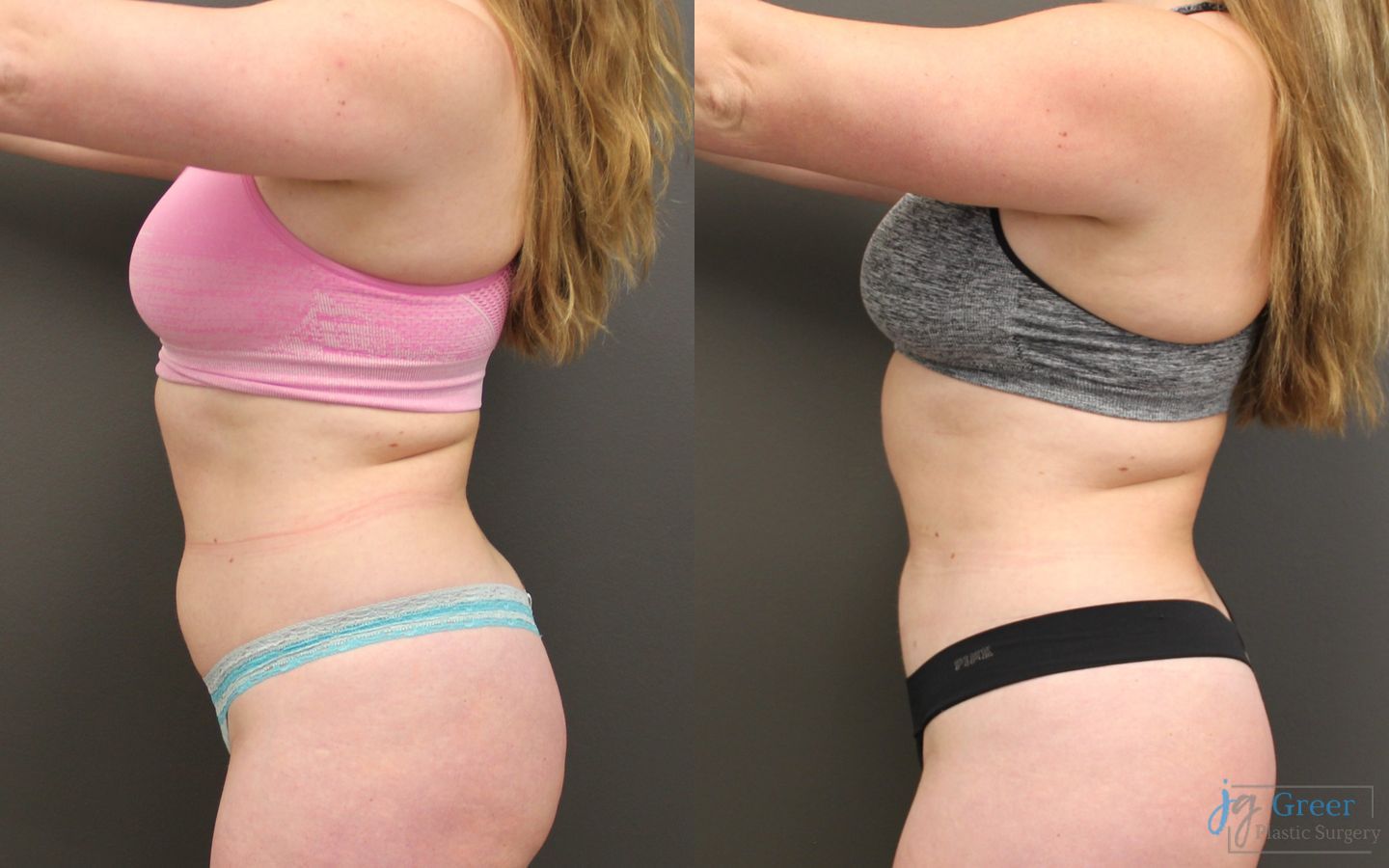 Before and after Liposuction case 19875 - Angle 3