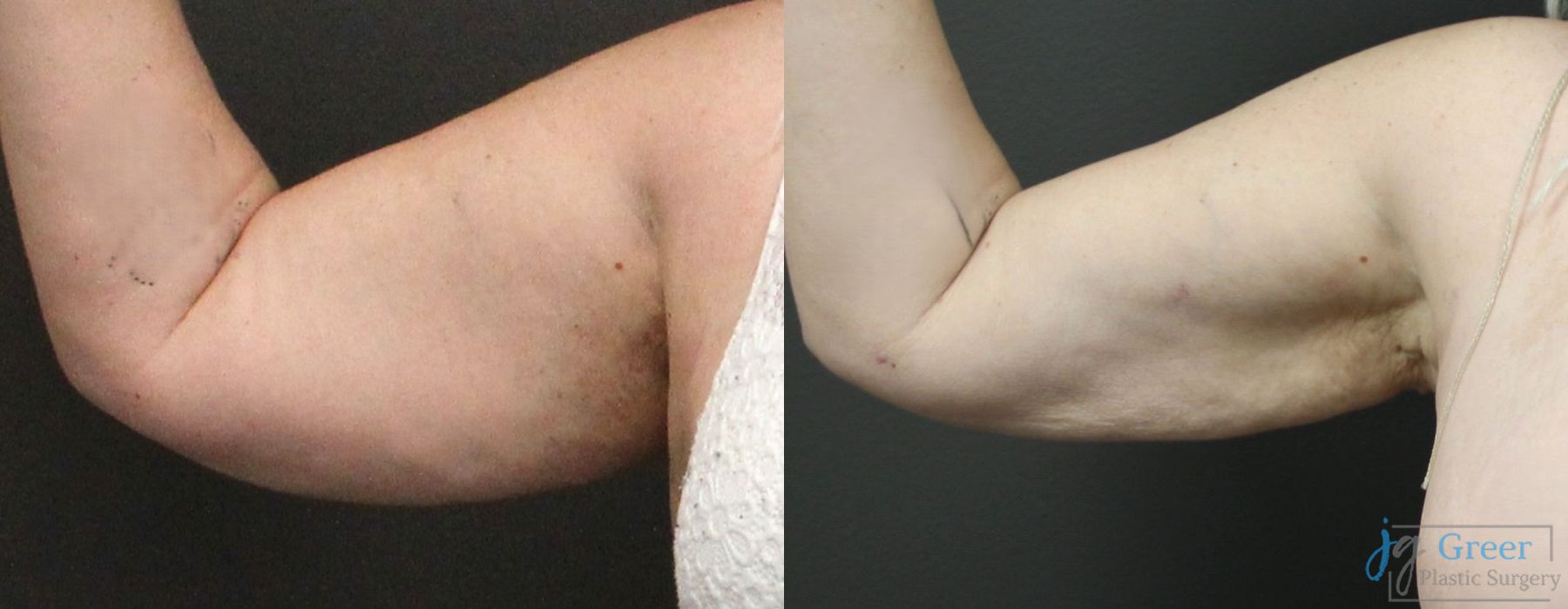 Liposuction - Case 2332