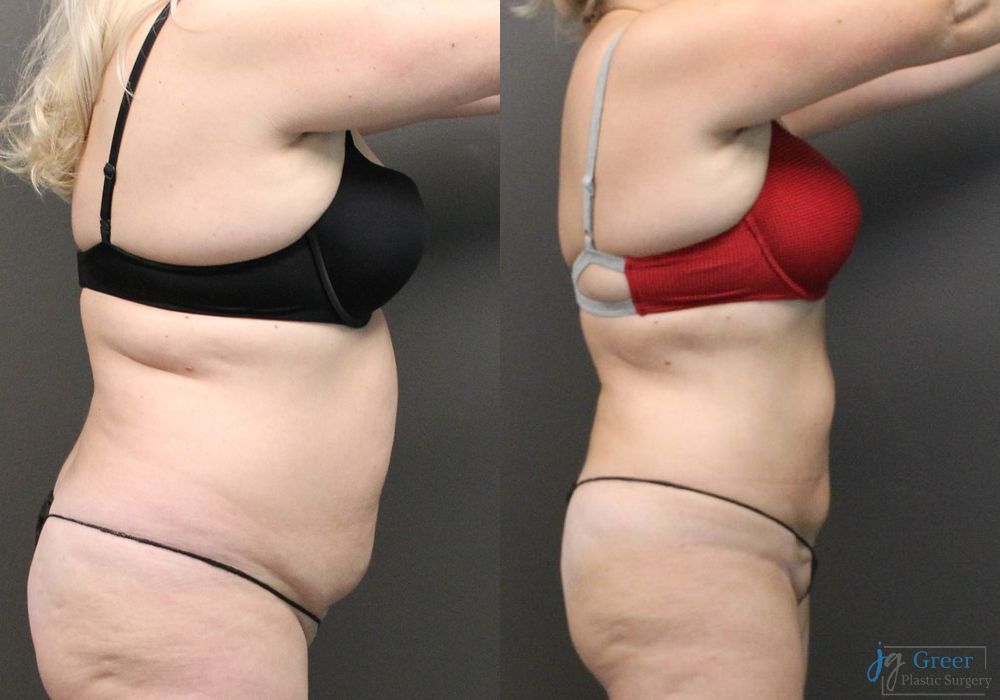 Liposuction - Thumbnail 3