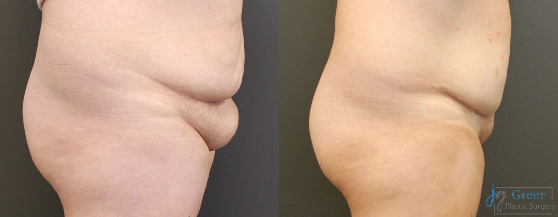 Liposuction - Thumbnail 2