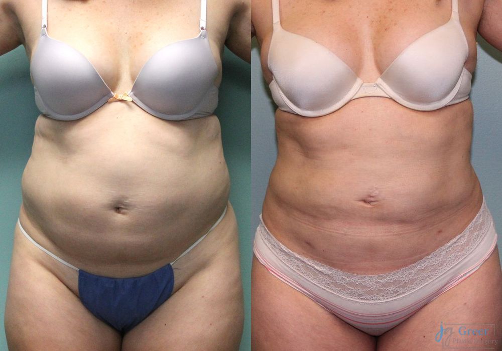 Liposuction - Case 2325