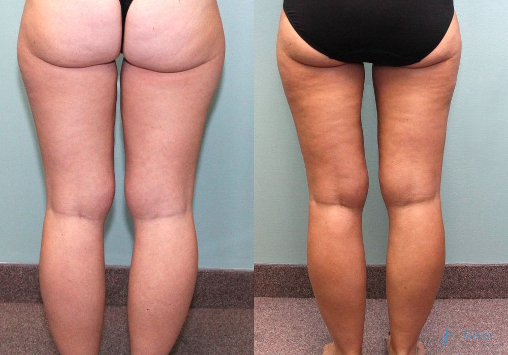 Liposuction - Thumbnail 2