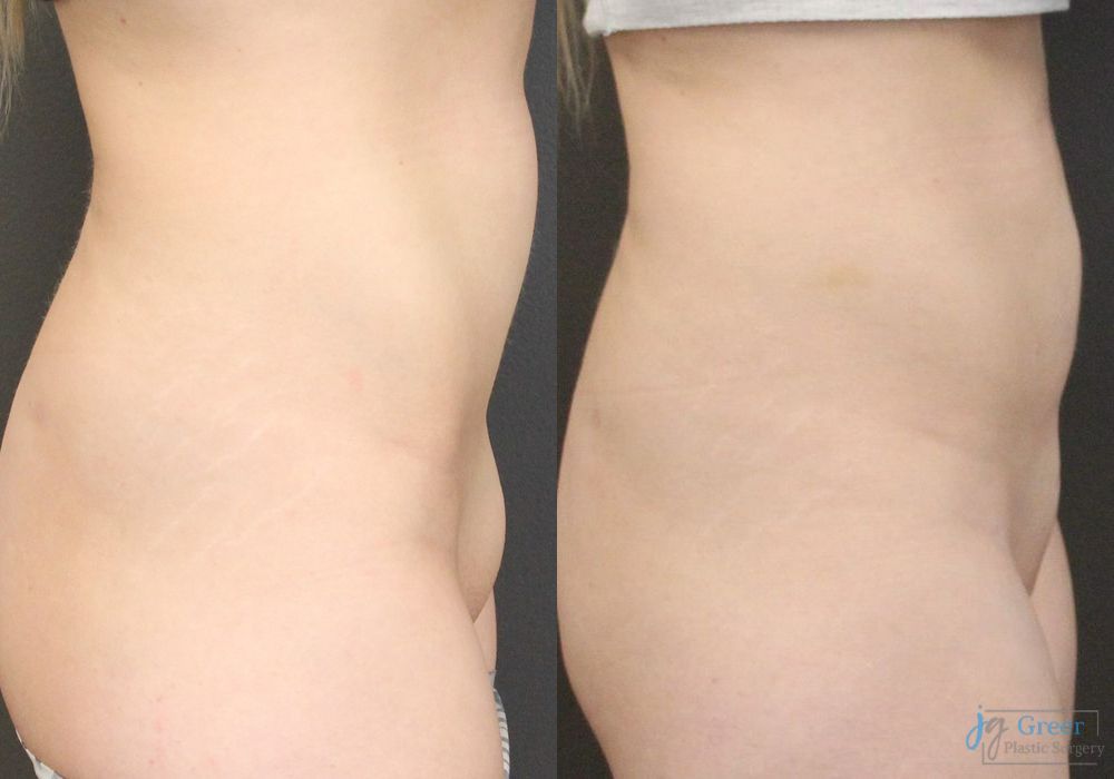 Before and after Liposuction case 19872 - Angle 2