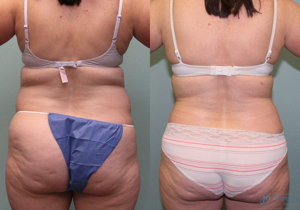 Liposuction - Thumbnail 2