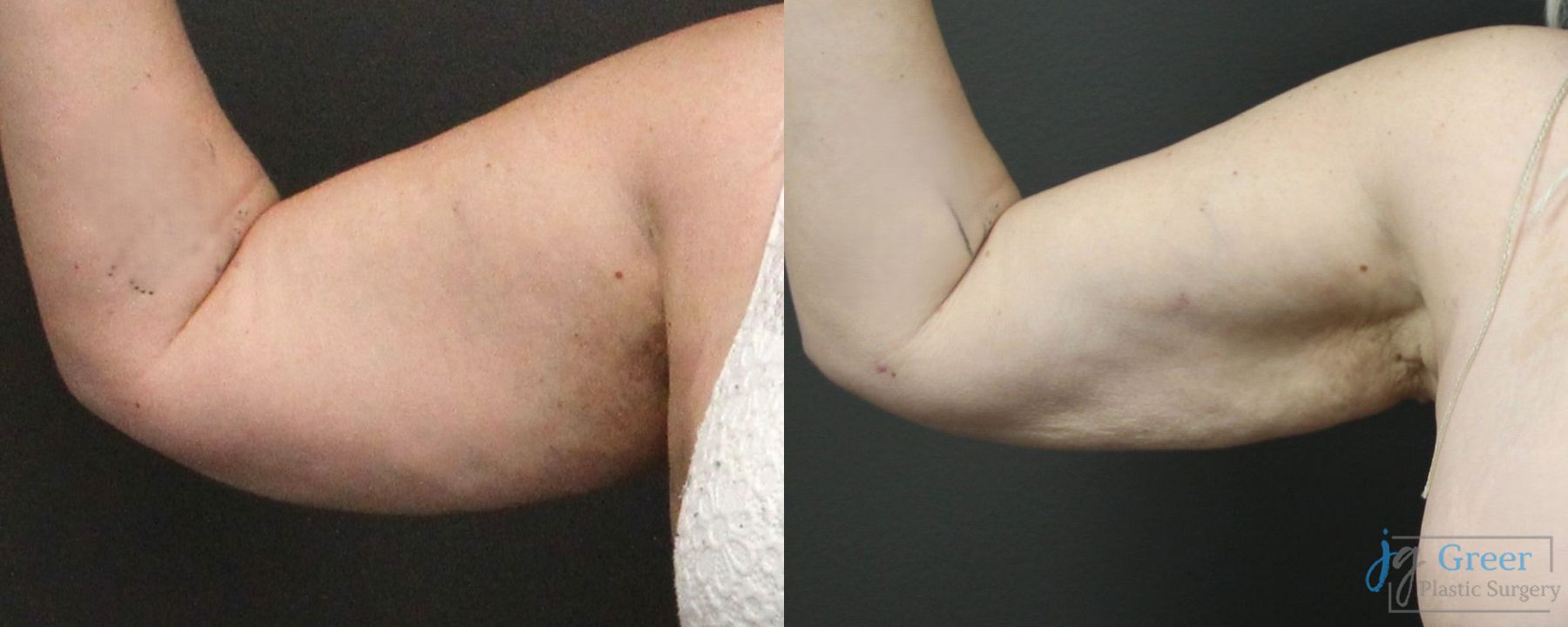 Before and after Liposuction case 19876