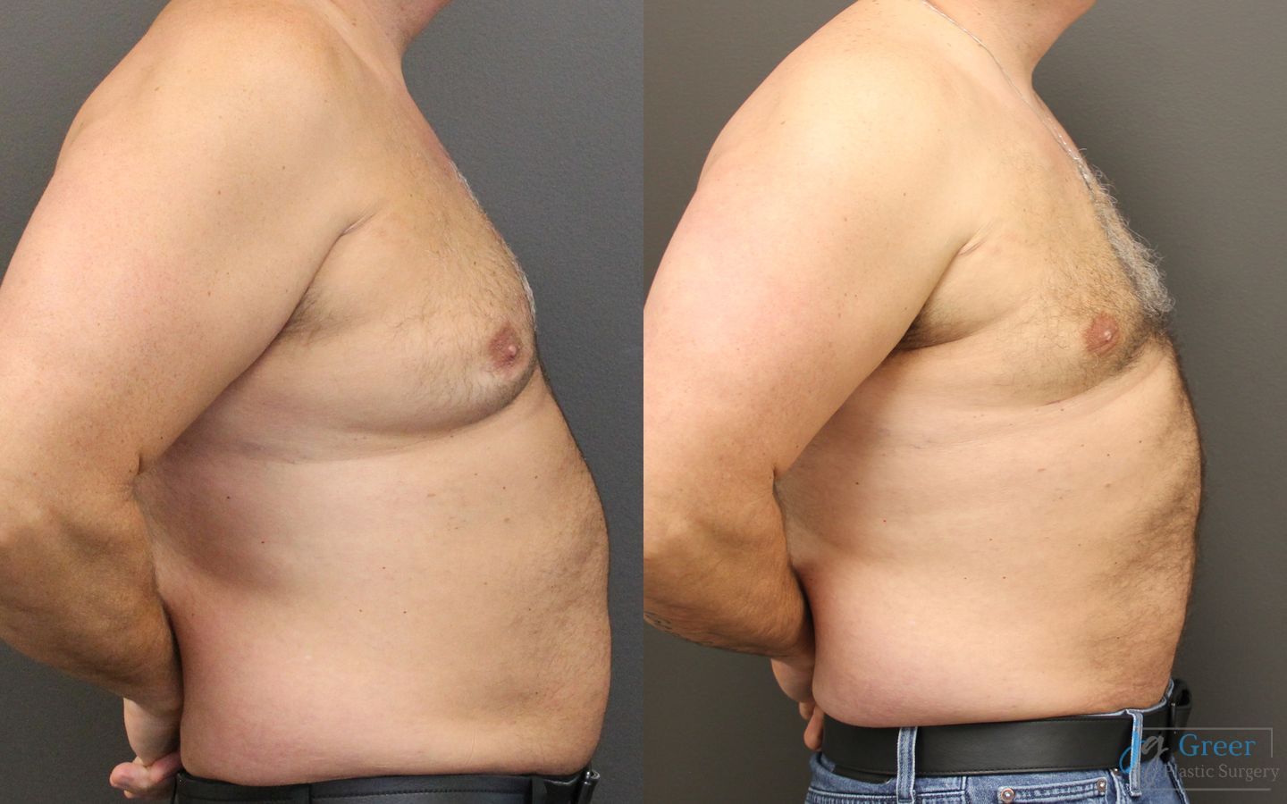 Before and after Liposuction case 19874 - Angle 2