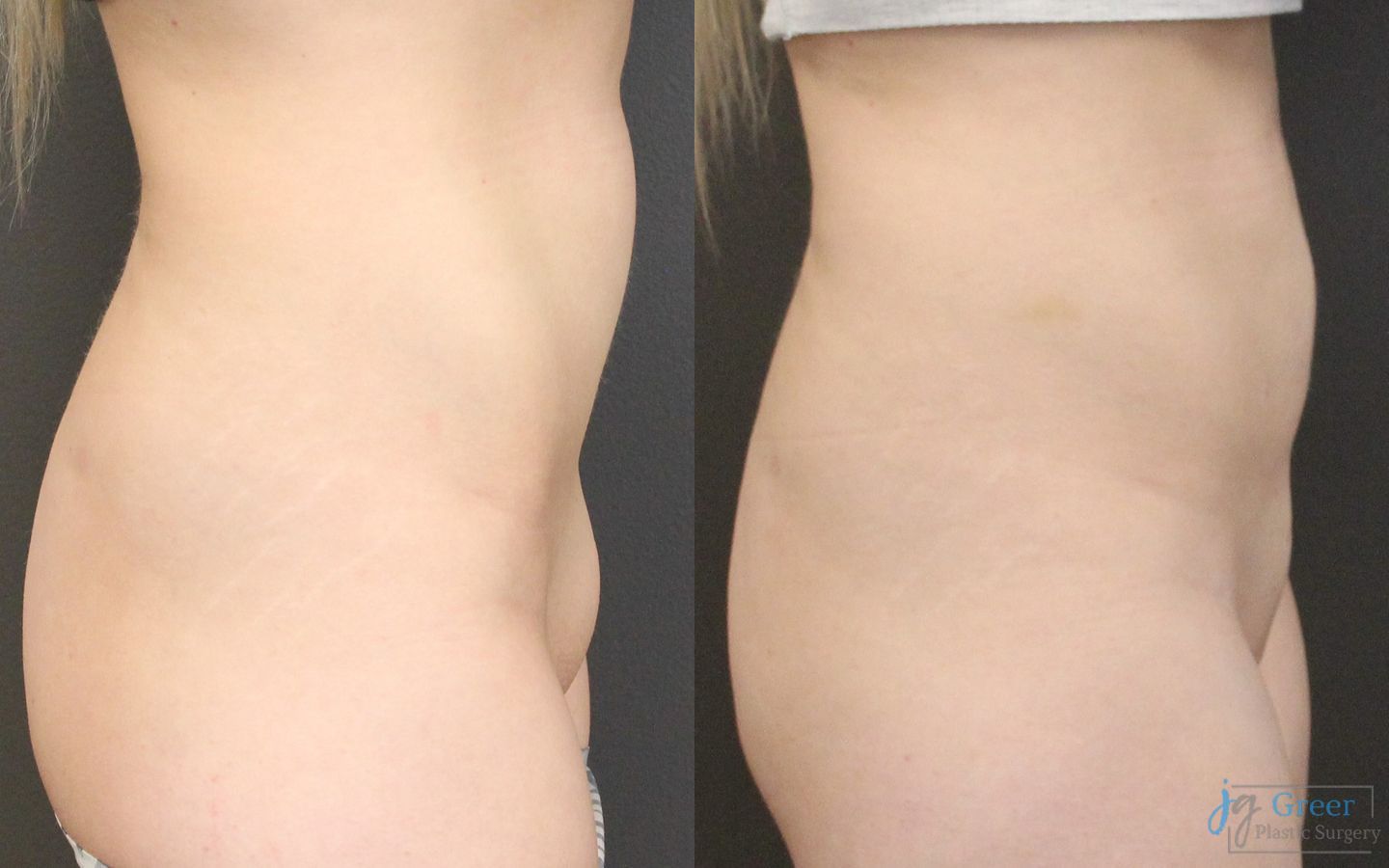 Before and after Monsplasty case 19872 - Angle 2
