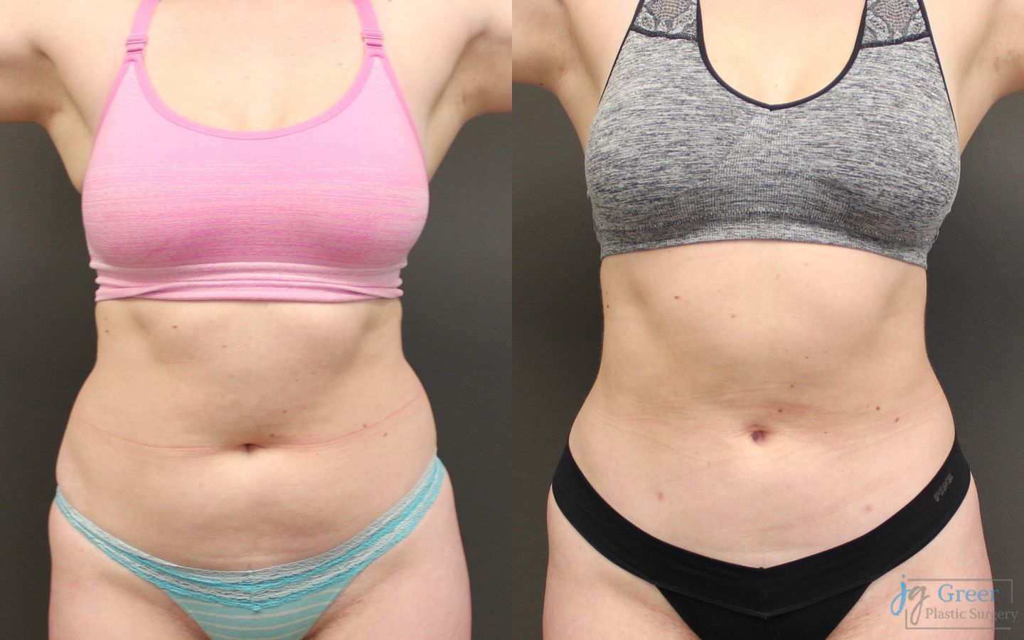 Before and after Liposuction case 19875
