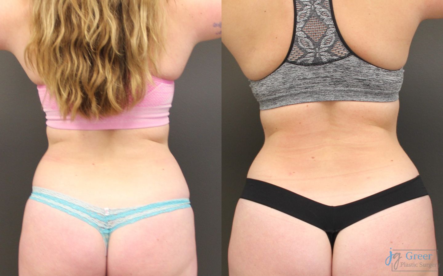Before and after Liposuction case 19875 - Angle 2