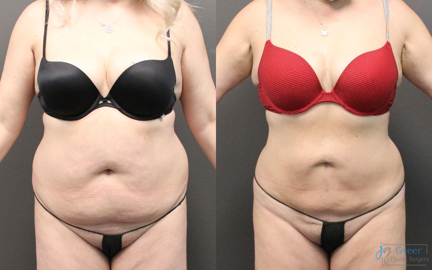 Before and after Liposuction case 19878