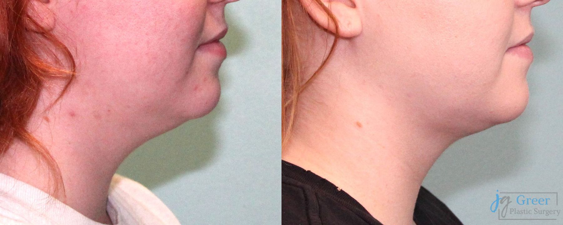 Before and after Liposuction case 19879 - Angle 2