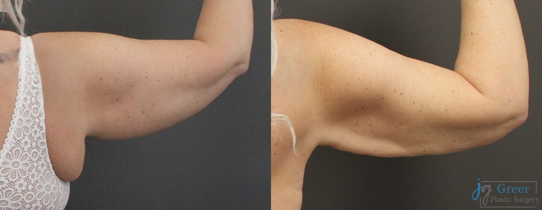 Liposuction - Thumbnail 2