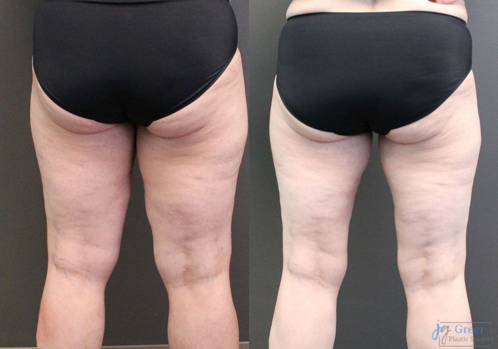 Liposuction - Thumbnail 2