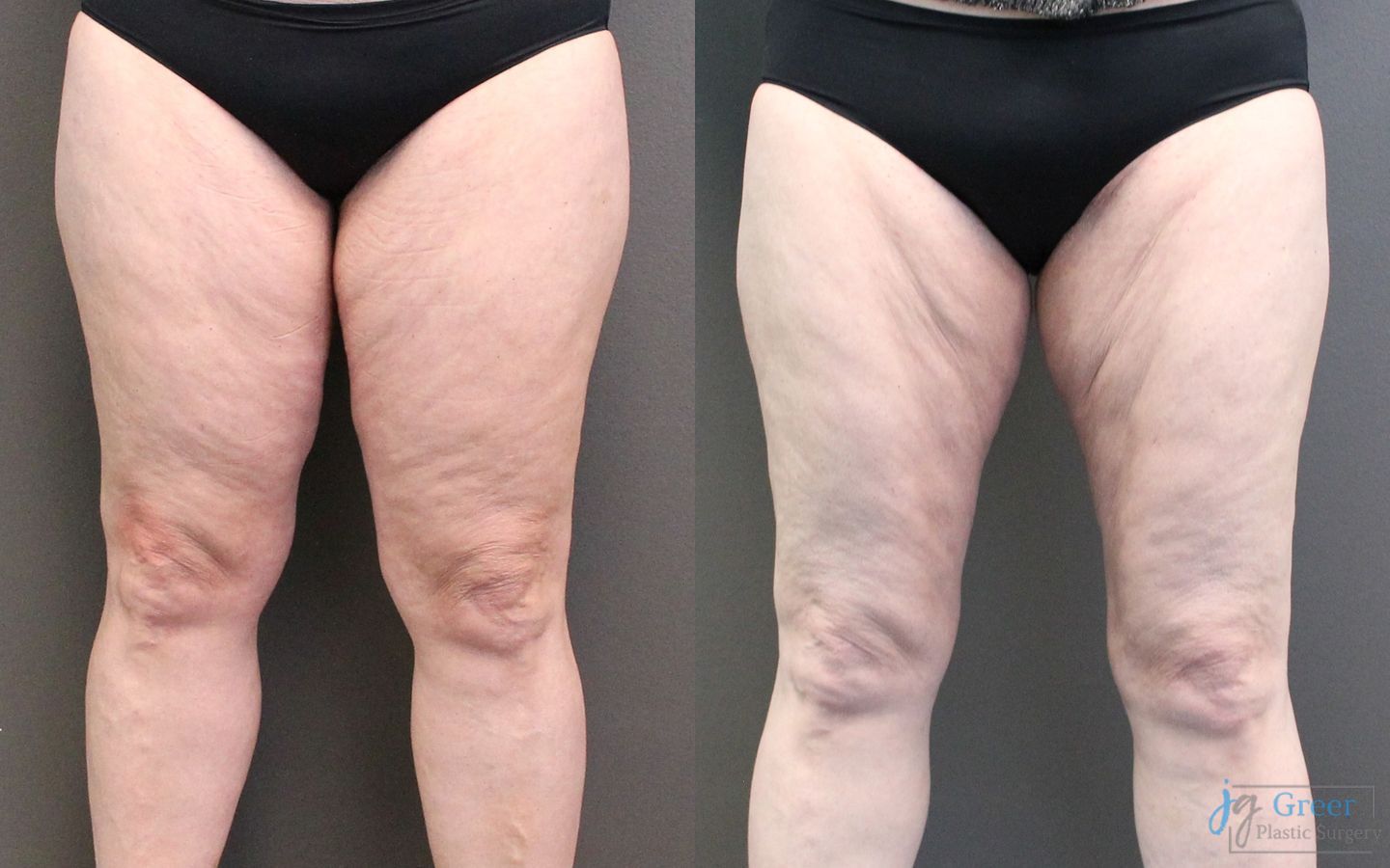 Before and after Liposuction case 19871