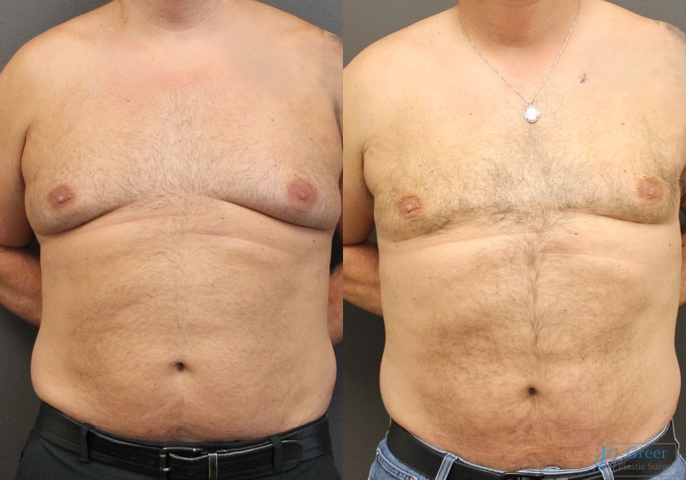 Gynecomastia - Case 2330