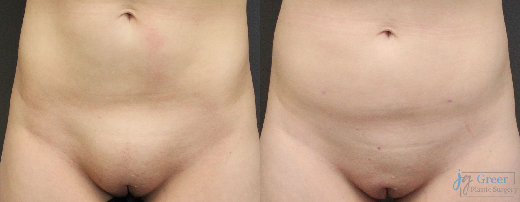 Before and after Liposuction case 19872
