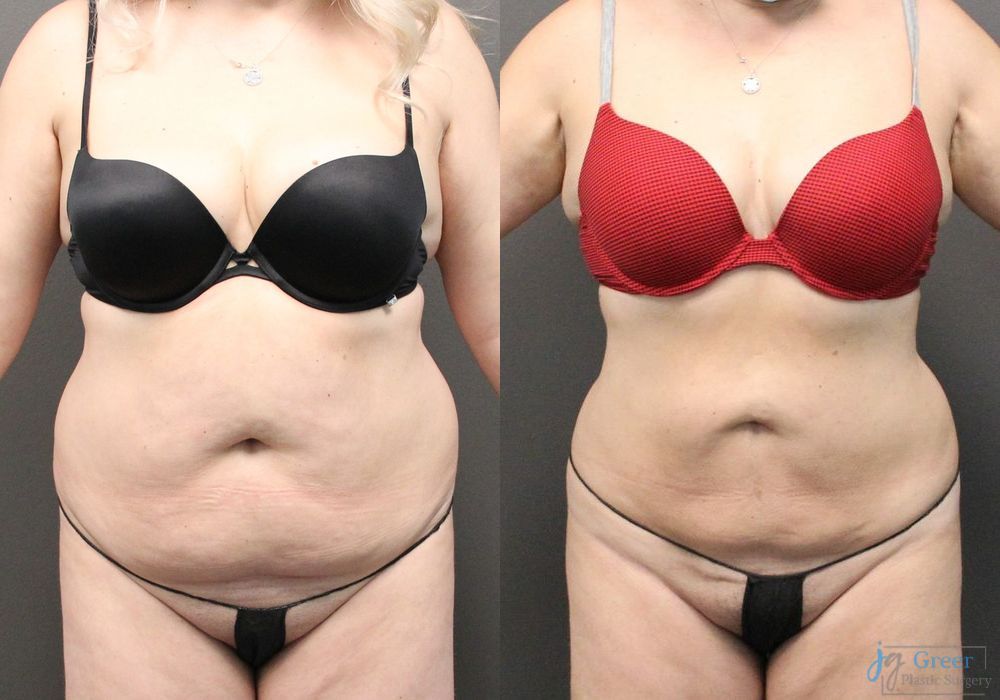 Liposuction - Case 2333