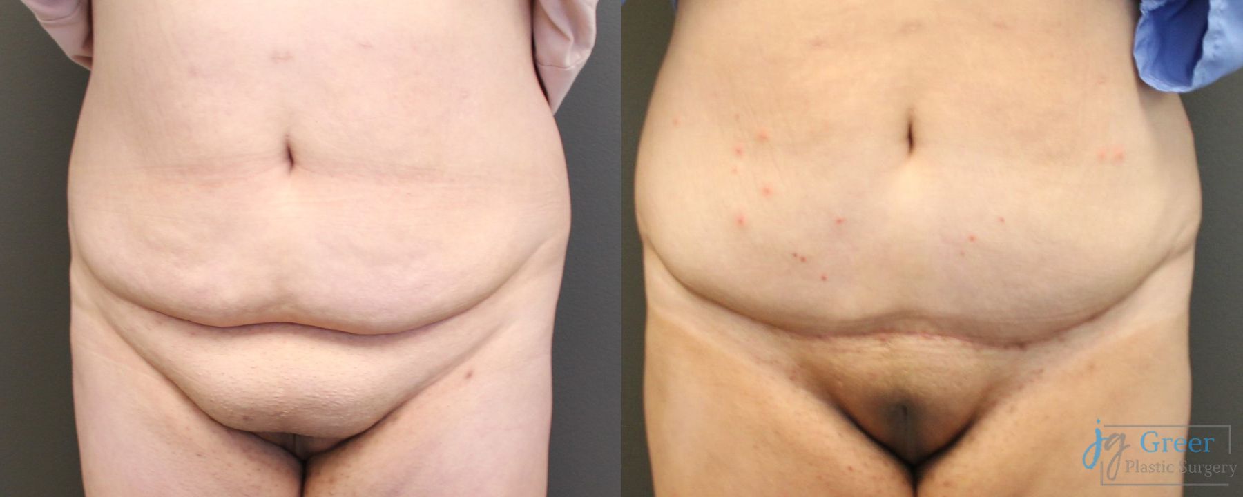 Before and after Monsplasty case 19873