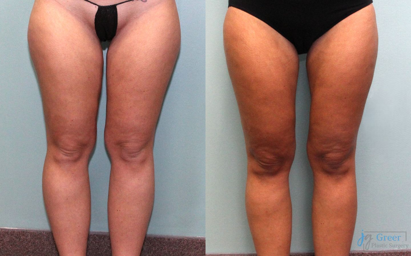 Before and after Liposuction case 19870