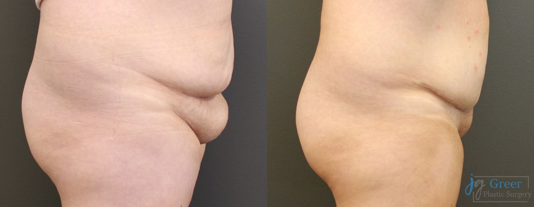 Before and after Liposuction case 19873 - Angle 2