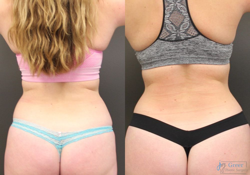 Liposuction - Thumbnail 2