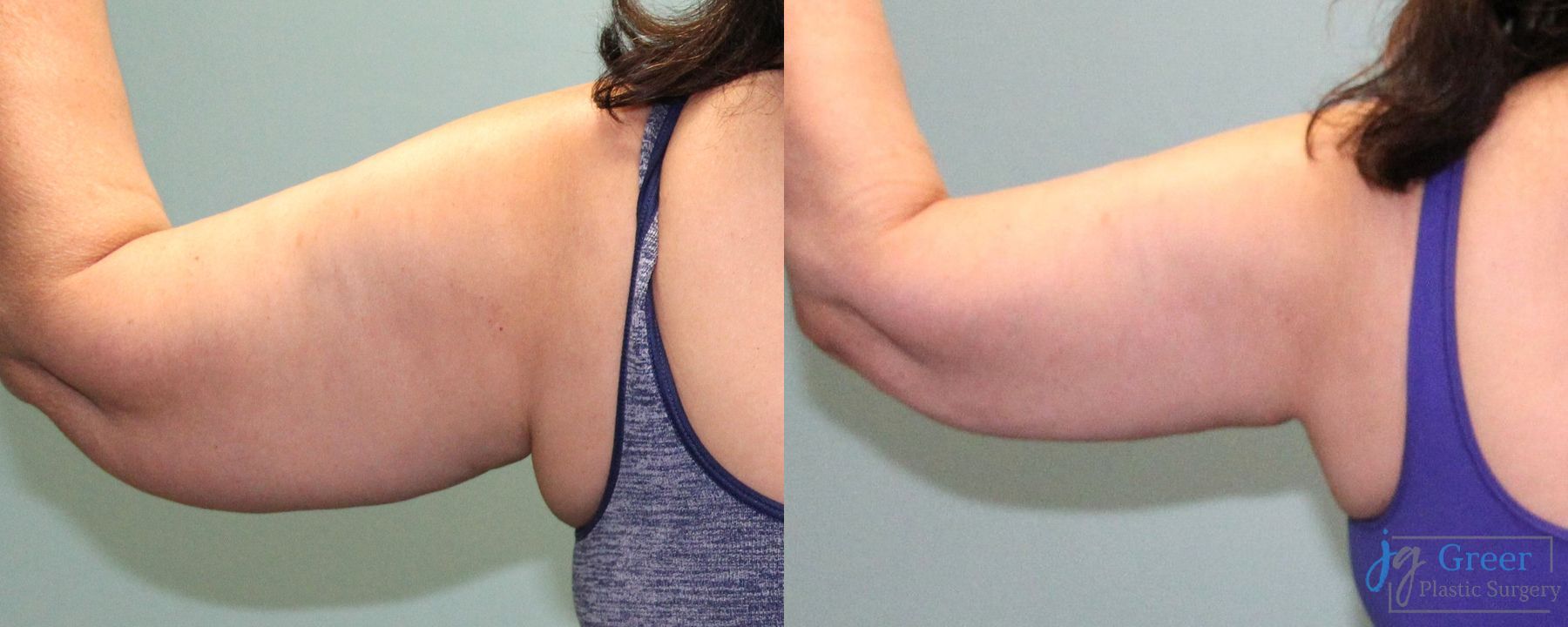 Before and after Liposuction case 19868 - Angle 4