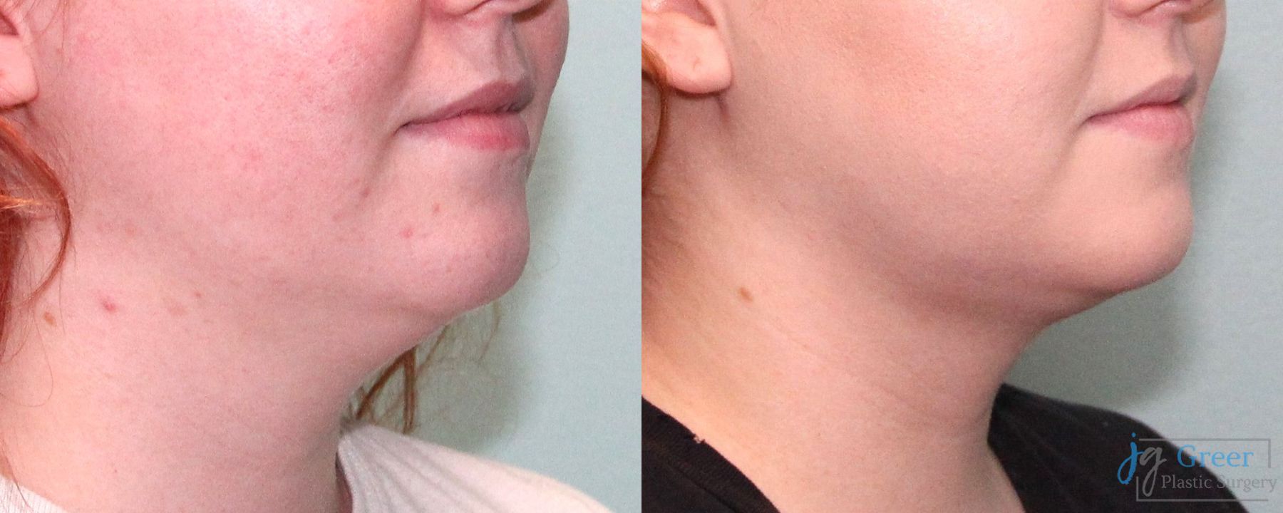 Before and after Liposuction case 19879 - Angle 3