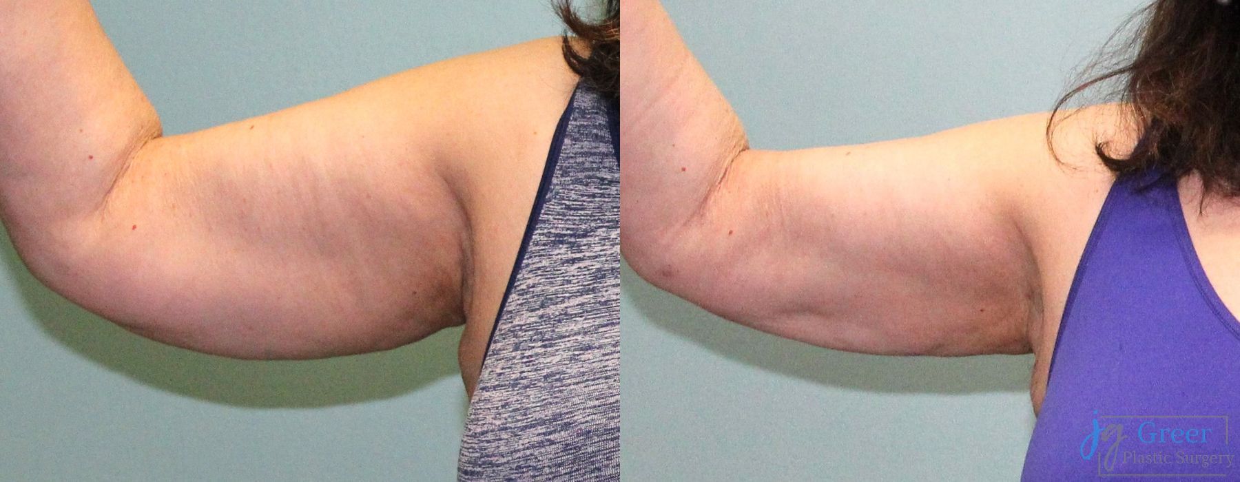 Liposuction - Case 2324